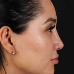 Rhinoplasty Before & After Patient #2895