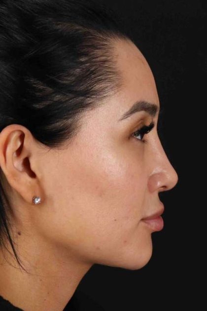 Rhinoplasty Before & After Patient #2895