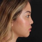 Rhinoplasty Before & After Patient #2906