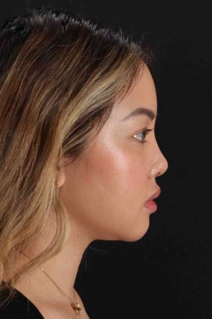 Rhinoplasty Before & After Patient #2906