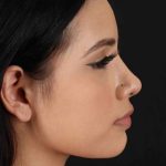 Rhinoplasty Before & After Patient #2917