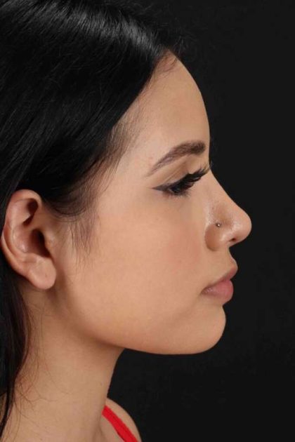 Rhinoplasty Before & After Patient #2917