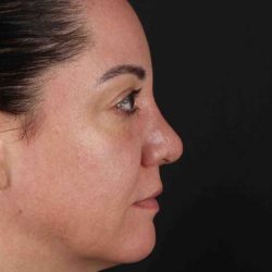 Browlift Before & After Patient #1363