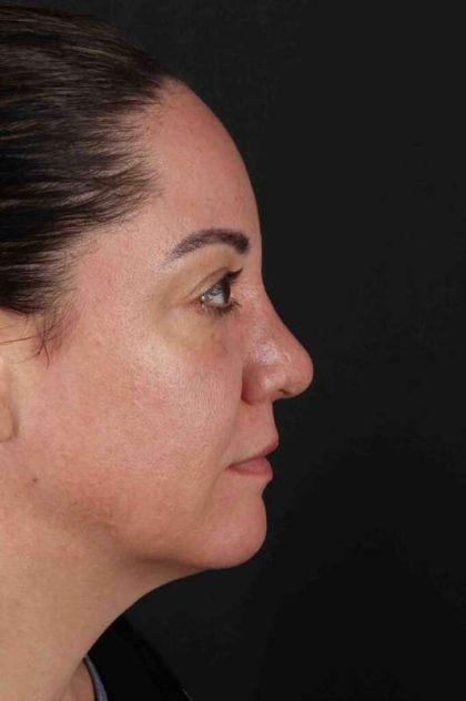 Browlift Before & After Patient #1363