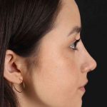 Rhinoplasty Before & After Patient #2928