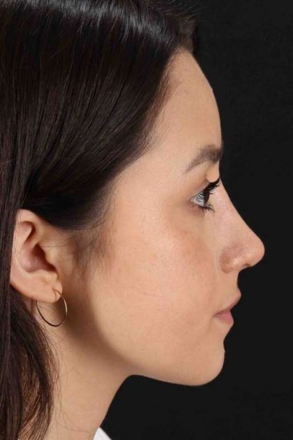 Rhinoplasty Before & After Patient #2928