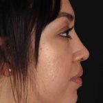 Rhinoplasty Before & After Patient #2939
