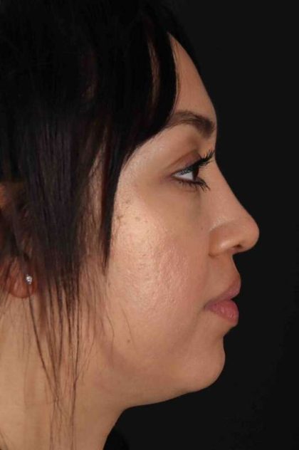 Rhinoplasty Before & After Patient #2939