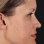 Rhinoplasty Before & After Patient #2950