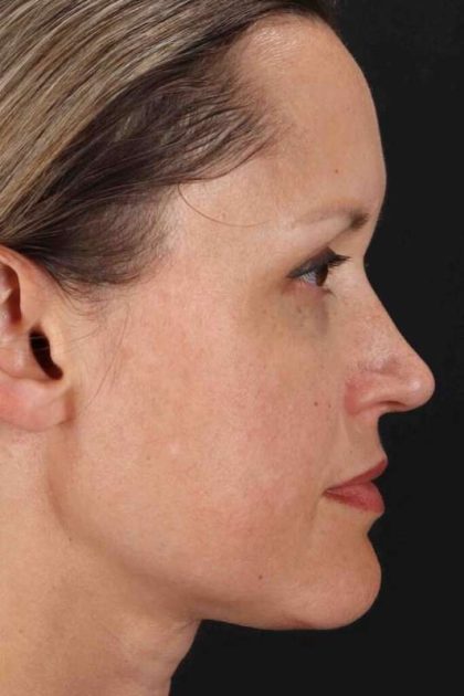 Rhinoplasty Before & After Patient #2950