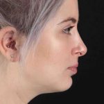 Rhinoplasty Before & After Patient #2961