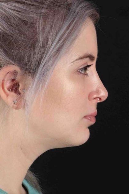 Rhinoplasty Before & After Patient #2961