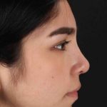 Rhinoplasty Before & After Patient #2972