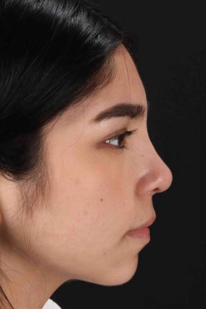 Rhinoplasty Before & After Patient #2972