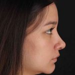Rhinoplasty Before & After Patient #2983