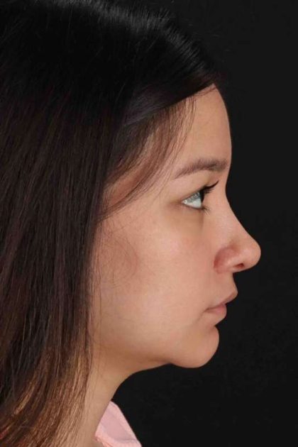 Rhinoplasty Before & After Patient #2983