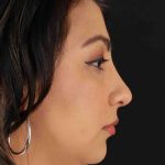 Rhinoplasty Before & After Patient #2994