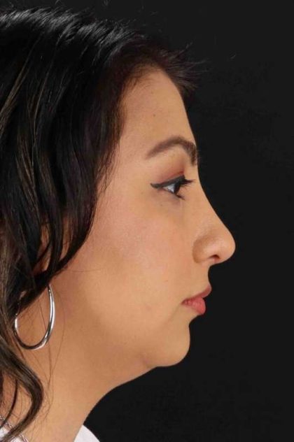 Rhinoplasty Before & After Patient #2994
