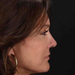Rhinoplasty Before & After Patient #3005