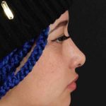 Rhinoplasty Before & After Patient #3016