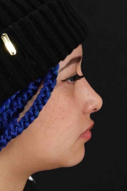 Rhinoplasty Before & After Patient #3016