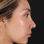 Rhinoplasty Before & After Patient #3027