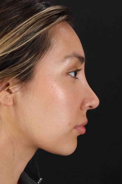 Rhinoplasty Before & After Patient #3027