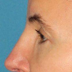 Browlift Before & After Patient #1373