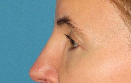 Browlift Before & After Patient #1373