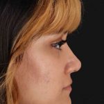 Rhinoplasty Before & After Patient #3038