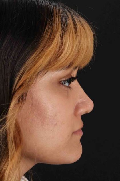 Rhinoplasty Before & After Patient #3038