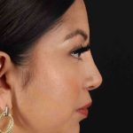 Rhinoplasty Before & After Patient #3049