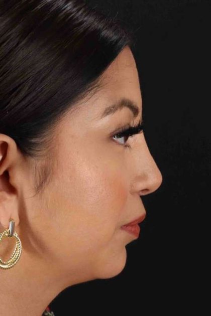 Rhinoplasty Before & After Patient #3049