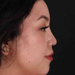 Rhinoplasty Before & After Patient #3060