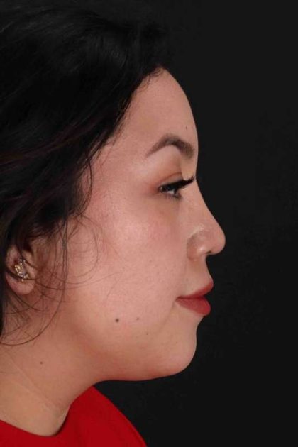 Rhinoplasty Before & After Patient #3060