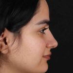 Rhinoplasty Before & After Patient #3071