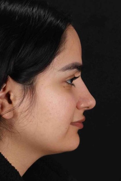 Rhinoplasty Before & After Patient #3071