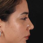 Rhinoplasty Before & After Patient #3082