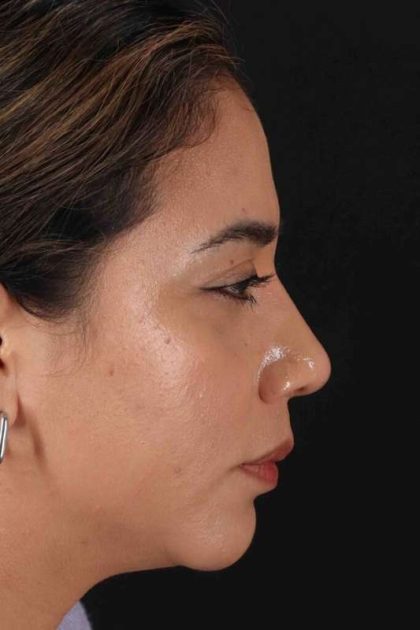 Rhinoplasty Before & After Patient #3082