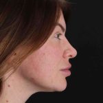 Rhinoplasty Before & After Patient #3093