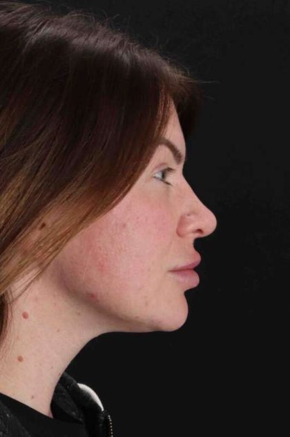 Rhinoplasty Before & After Patient #3093