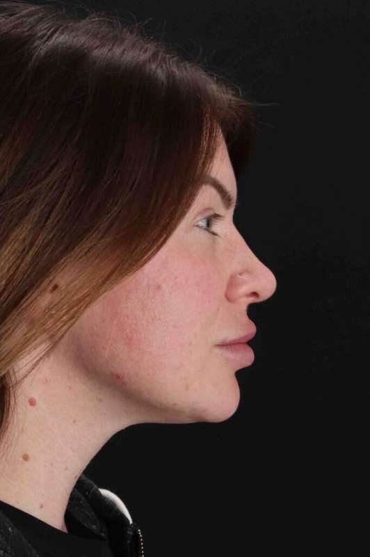 Rhinoplasty Before & After Patient #3093