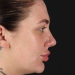 Rhinoplasty Before & After Patient #3104