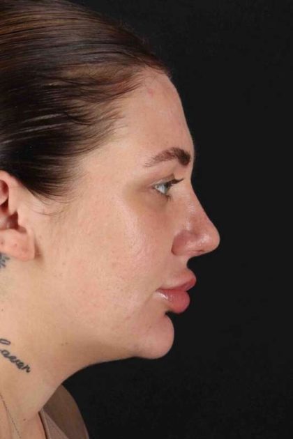 Rhinoplasty Before & After Patient #3104