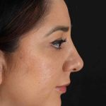 Rhinoplasty Before & After Patient #3115