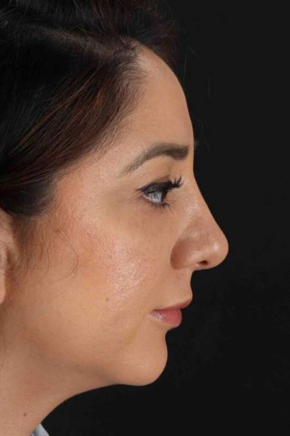 Rhinoplasty Before & After Patient #3115
