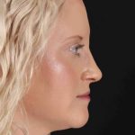 Rhinoplasty Before & After Patient #3126