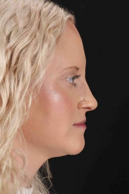 Rhinoplasty Before & After Patient #3126