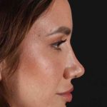 Rhinoplasty Before & After Patient #3137