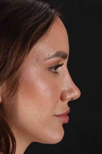 Rhinoplasty Before & After Patient #3137